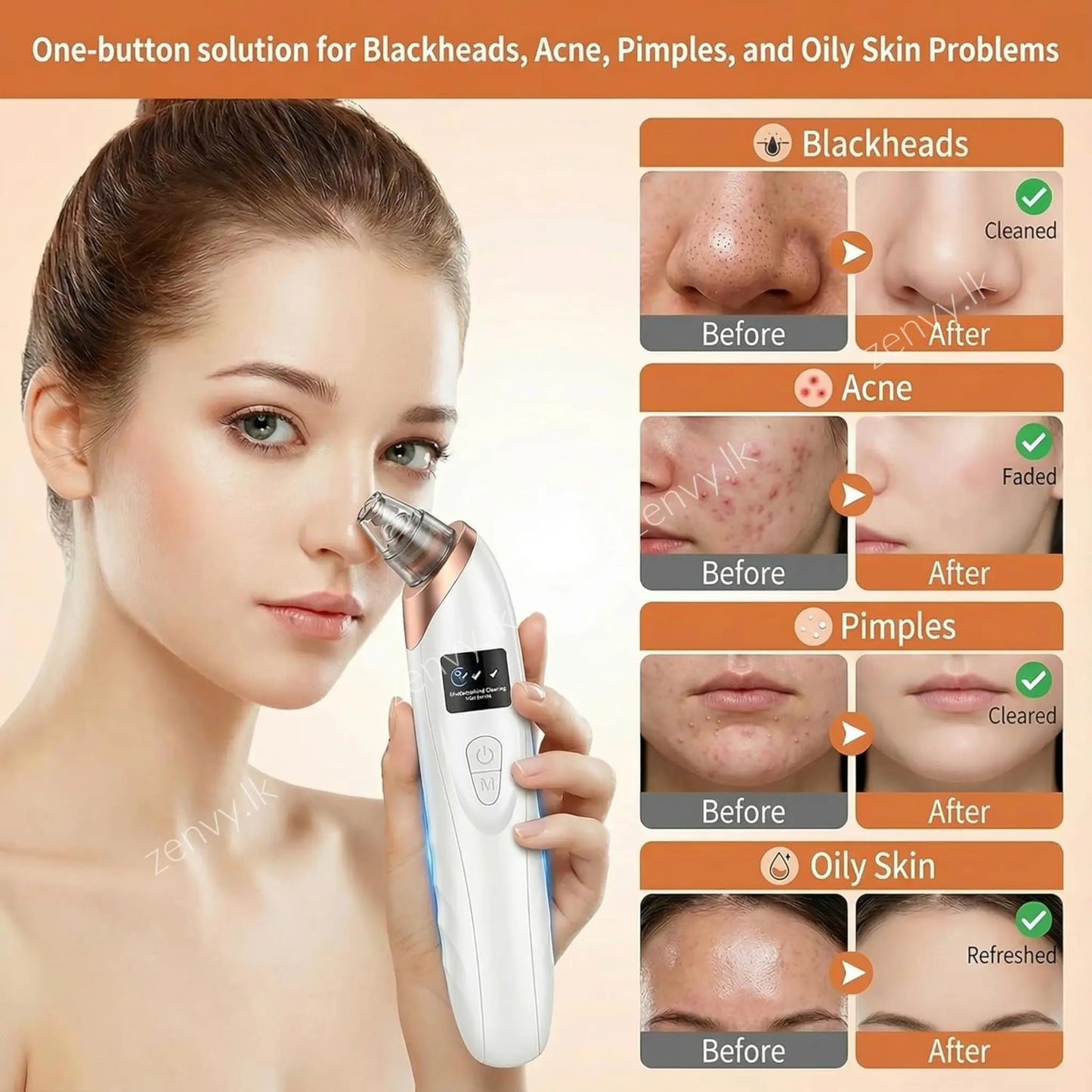 Buy Rechargeable Pore & Blackhead Remover Vacuum for Face in Sri Lanka