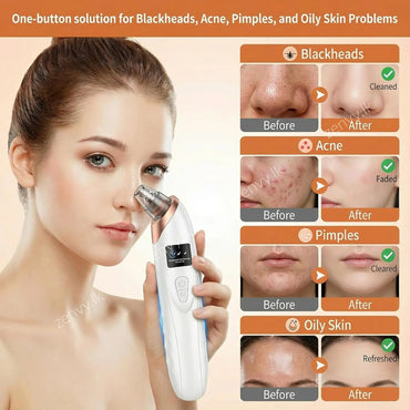 Buy Rechargeable Pore & Blackhead Remover Vacuum for Face in Sri Lanka