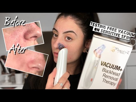 Buy Rechargeable Pore & Blackhead Remover Vacuum for Face in Sri Lanka