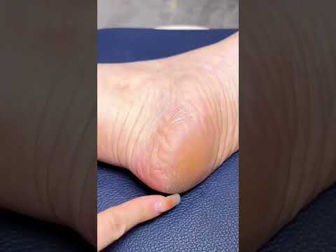 Buy Electric Callus Remover for Feet Online in Sri Lanka